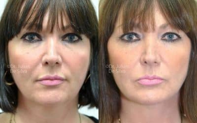 How To Get Rid of Face Fat Permanently