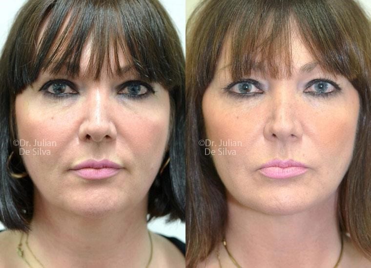 Female face, before and after Mini Facelift treatment, front view, patient 19