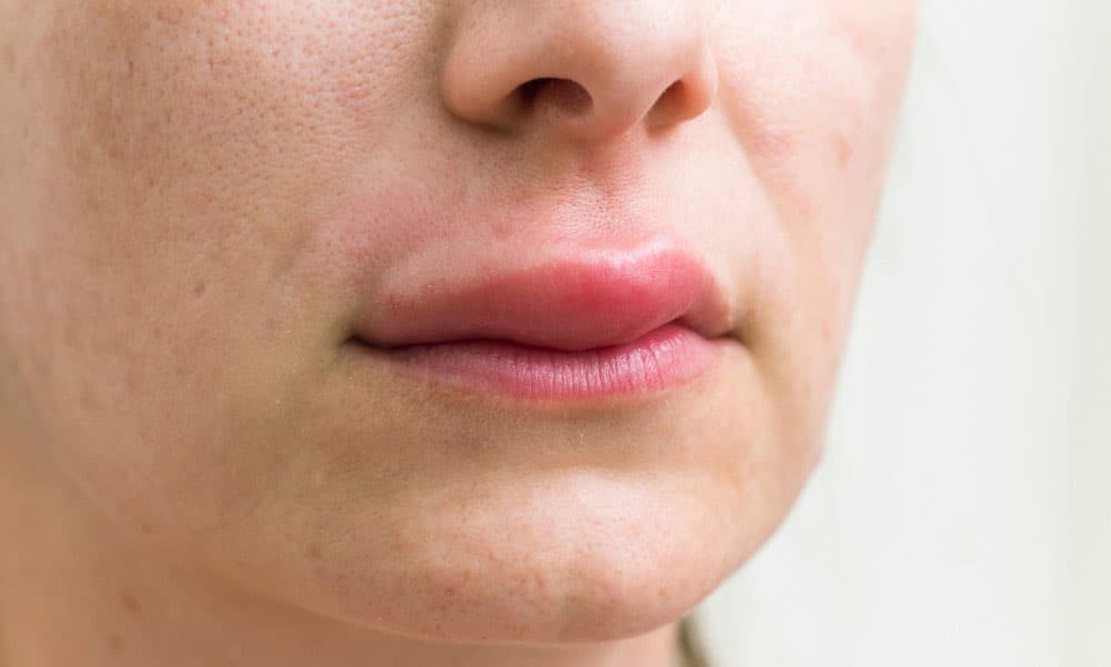 You can take medically reviewed steps to bruising on your swollen face after facial or jaw surgery.