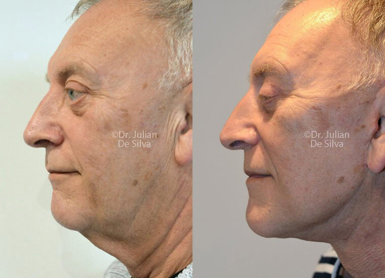 Male face, before and after turkey neck treatment, side view patient 3