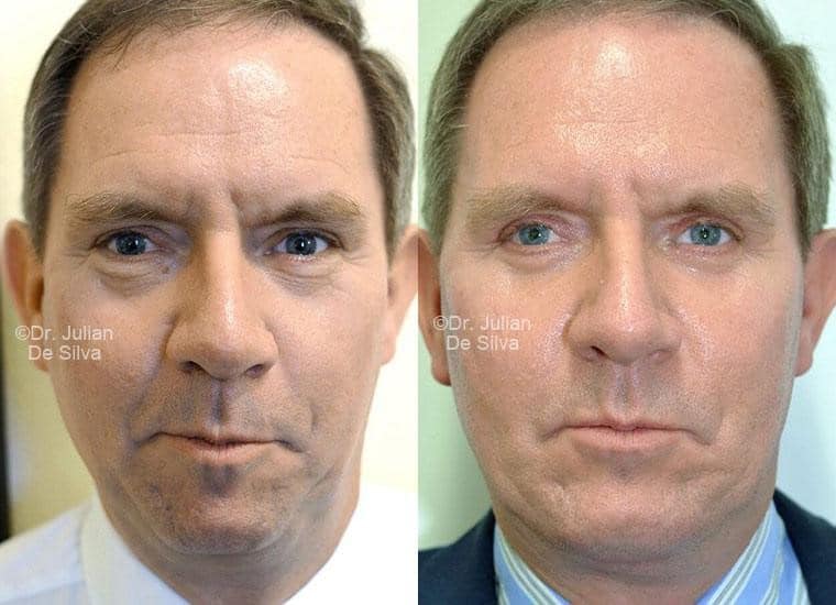 Male face, before and after Facelift treatment, front view, patient 3