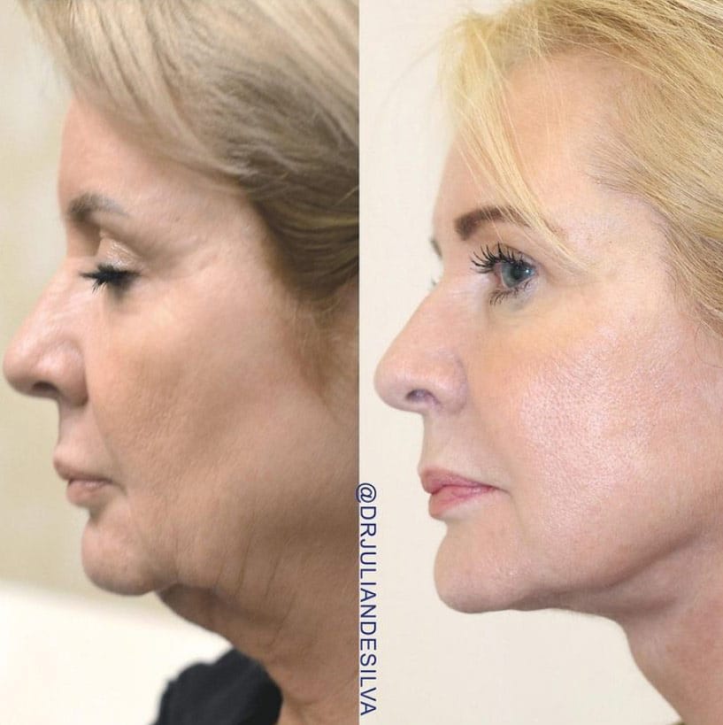Female face, before and after turkey neck treatment, side view patient 1