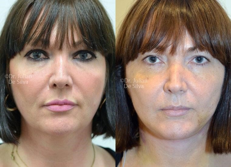 Female face, before and after Facelift treatment, front view, patient 5