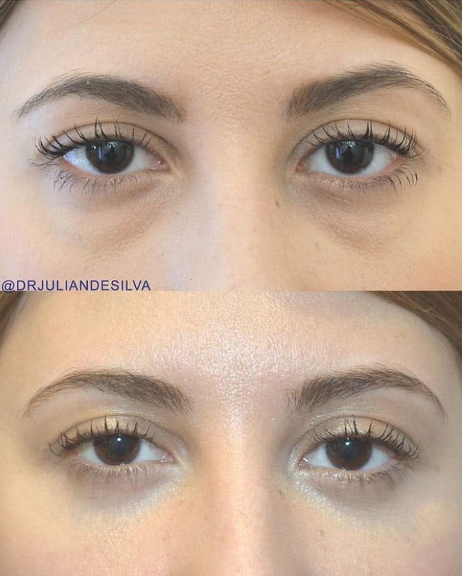 Woman's face, before and after Eye Bag Removal Surgery (Blepharoplasty), front view, patient 1