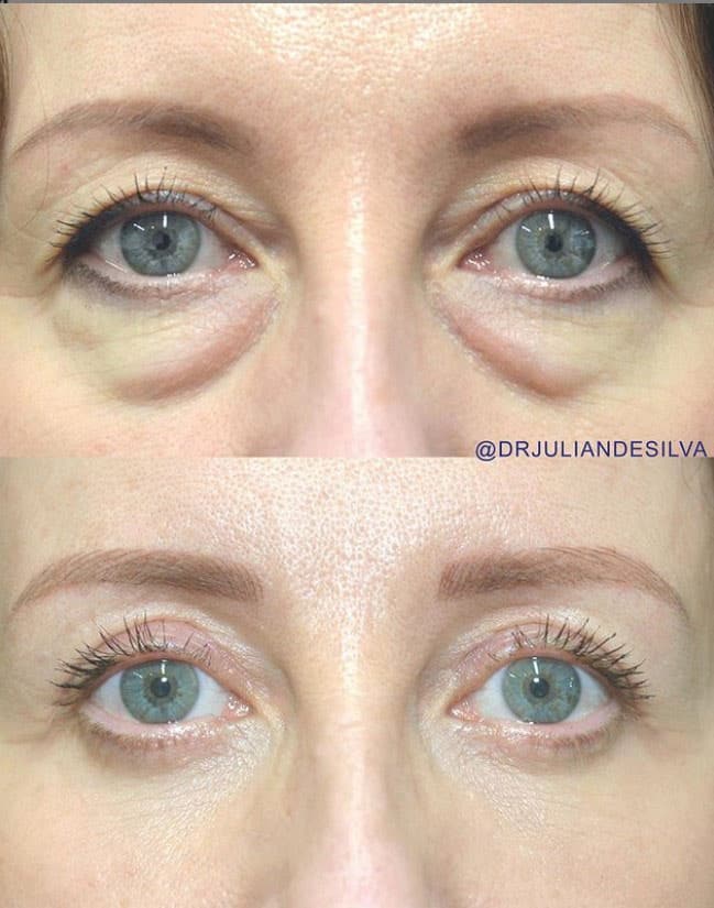 Woman's face, before and after Eye Bag Removal Surgery (Blepharoplasty), front view, patient 2  