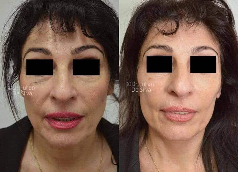 This 55-year-old woman was dissatisfied with the drooping soft tissues beneath her jaw and droopy neck muscles.