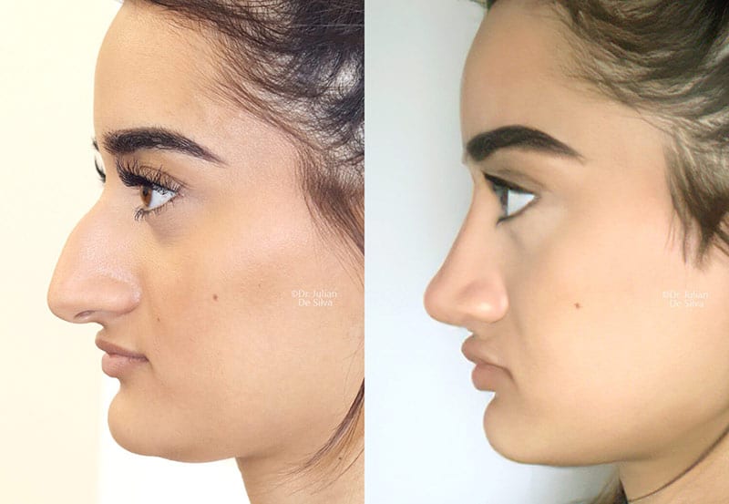 Woman's face, Before and After Rhinoplasty recovery, side view