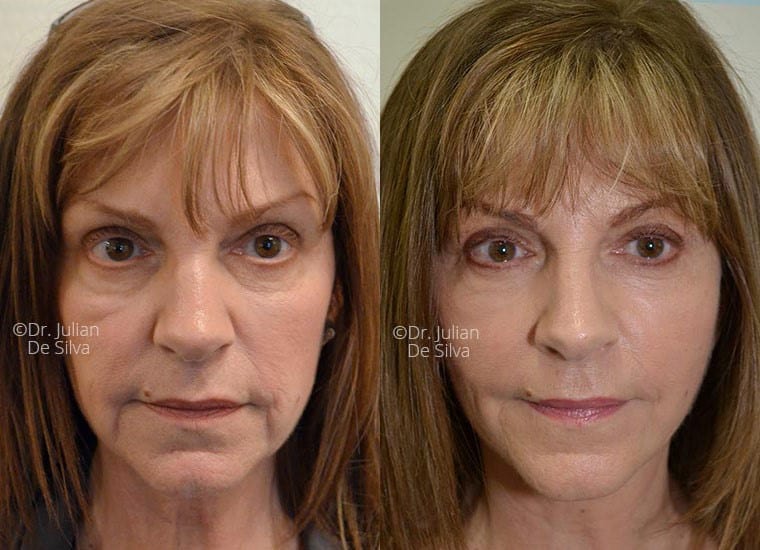 Face Lift - before and after