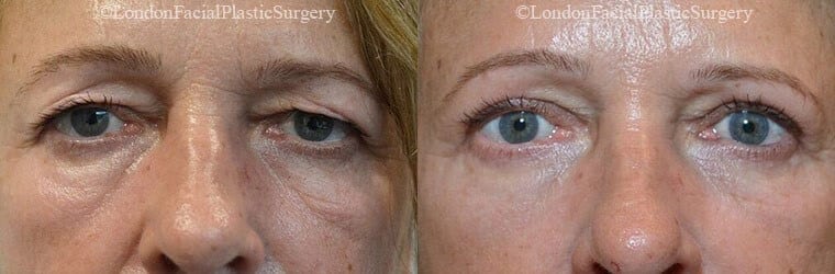 Under eye wrinkles - before and after treatment