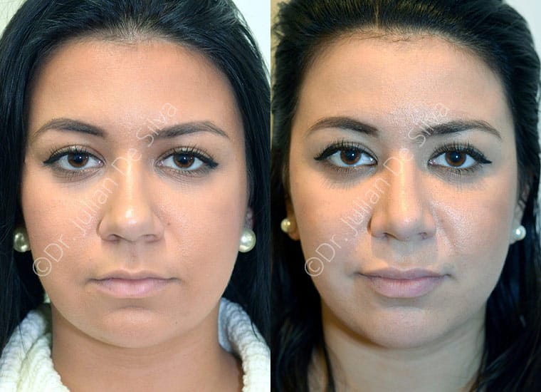 Woman's face, Before and After nose job, front view, patient 2