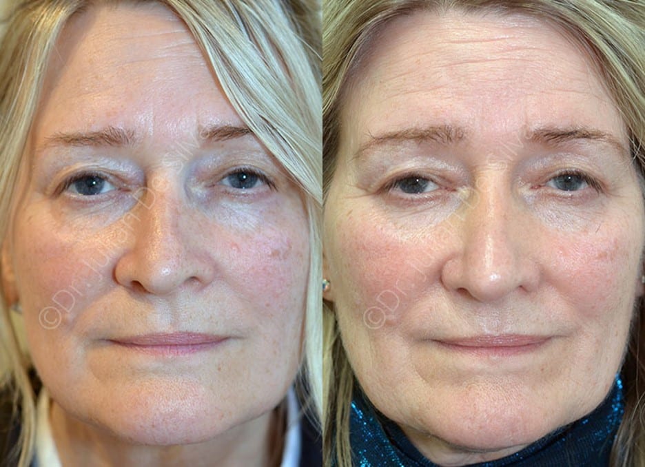 Woman's face, Before and After scars treatment, front view, patient 3