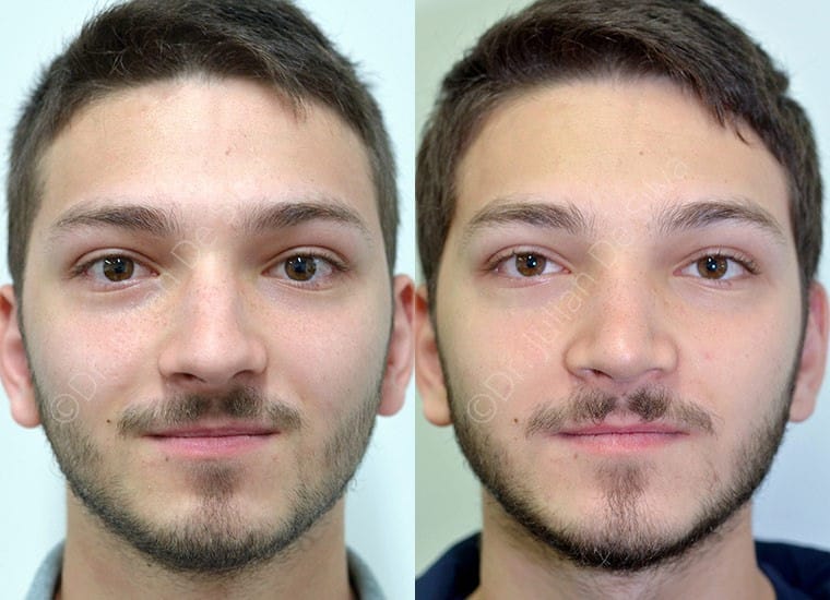Male face, Before and After nose job, front view, patient 4