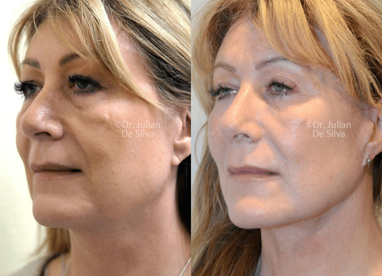 Contemplating a facelift? It's imperative to seek an experienced cosmetic surgeon. 