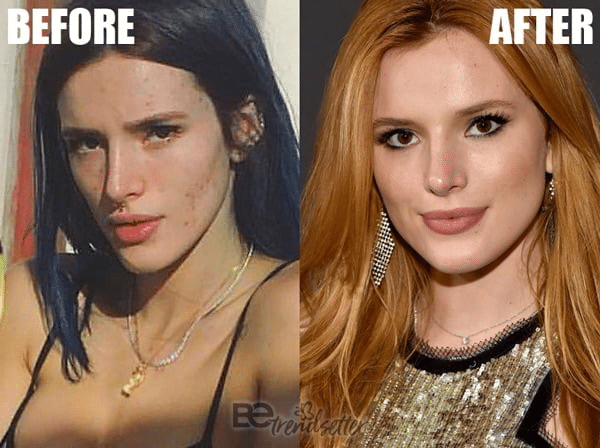 Bella Thorne, a well-known actress and singer, has been candid about her cosmetic procedures, including her experience with a thread lift.