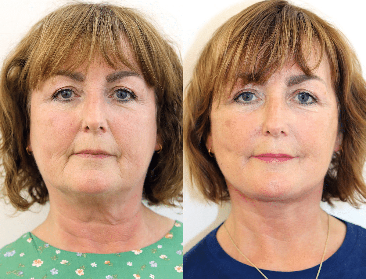 The traditional facelift has given birth to modern techniques that many patients get nowadays. 