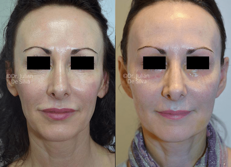 This woman, in her forties, became increasingly aware of her tired-looking appearance, characterized by loose skin, early jowls, and volume loss.