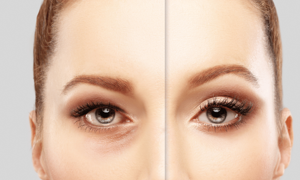 Lower blepharoplasty is a type of facial cosmetic surgery that removes excess skin under the eyes. Also known as lower blepharoplasty, this lower eyelid technique improves the appearance of the lower eyelid through muscle or tissue tightening, excess fat removal, and skin excision. This procedure is performed to treat under-eye bags, drooping lower eyelids, under-eye wrinkles, and dark under-eye circles. Both adult men and women looking for a younger, fresher look can undergo this treatment. While expectations and results vary per person, the procedure offers improvements across the face by reducing loose, sagging skin and puffy eye bags.