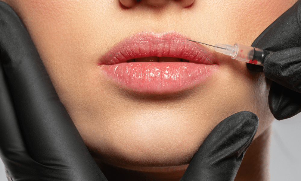 A lip lift helps fix the distance between the nose and lips for a brighter smile and face.