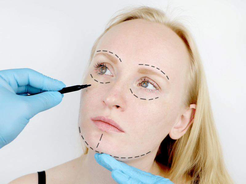 Non-surgical face lift procedures require no stitches, while a one-stitch mini facelift involves the least invasive techniques.