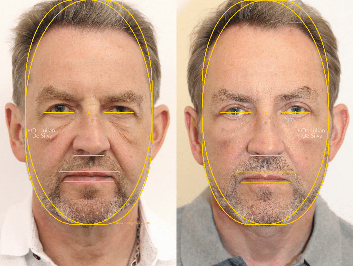 This patient had my signature facelift and neck lift. He came to me after deciding to take action to change his look.