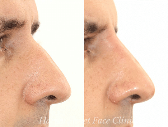Yes, cosmetic surgery can fix nasal speech by altering the shape and size of the nose. 