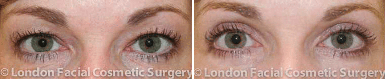 A before and after photo of a patient who had blepharoplasty with Dr. Julian De Silva. 