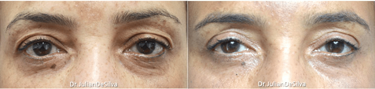 A 51-year-old Asian woman was noted for having significant heaviness in her upper lids, along with sun damage on her face.