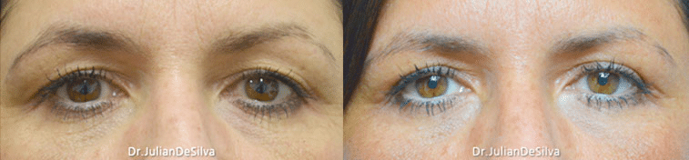 A 50-year-old female patient complained of heavy upper lids that caused her to look tired.