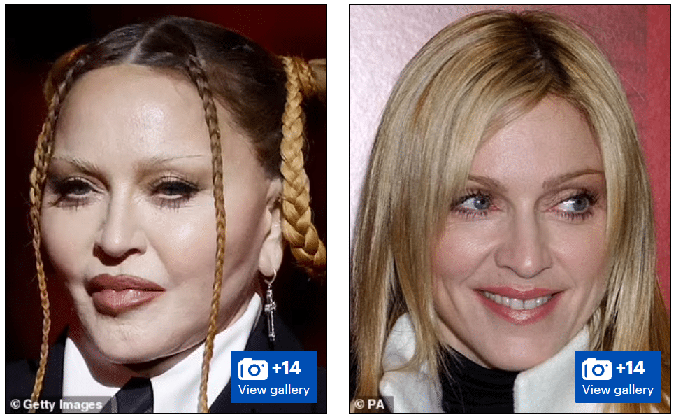Madonna's appearance at the 2023 Grammy's at Crypto Arena caused concern among fans and more plastic surgery rumors among the rest.