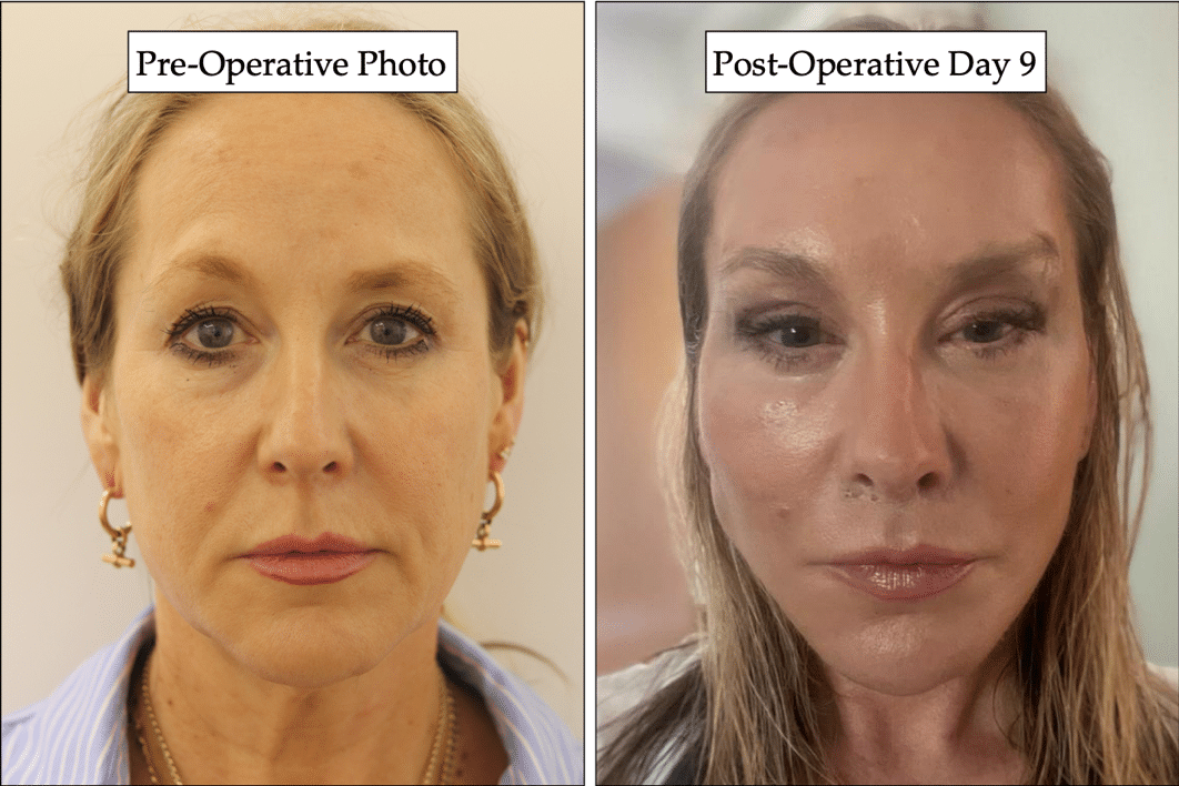 A before and after photo of a patient who went under vertical face restore with Dr. Julian De Silva.