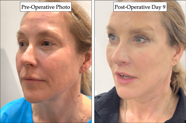 During the procedure, excess fat is removed from under the chin while the underlying muscles are tightened up. Traditional facelift lifts towards ears, vertical facelift restore lifts vertically upwards, reversing effect of gravity