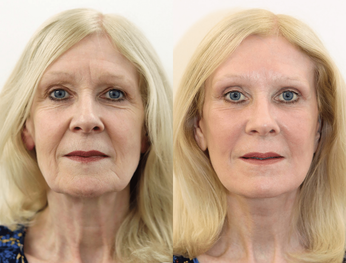Vertical face restore involves risks and side effects that usually go away. 
