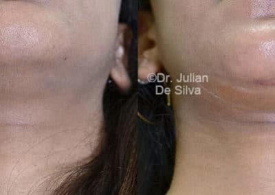 Chin Implants in London Before & After Results