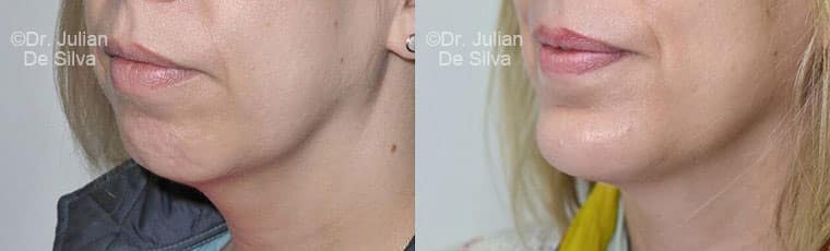 Chin Implants in London Before & After Results