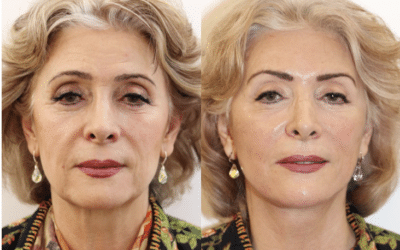 Everything You Should Know Before Considering a Facelift