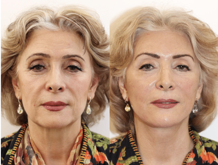 Everything You Should Know Before Considering a Facelift