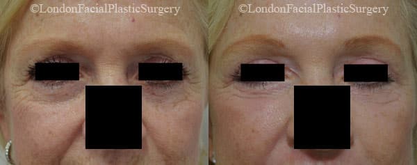 Facelift in London Before & After Results