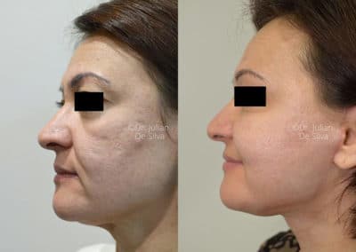 Facelift in London Before & After Results
