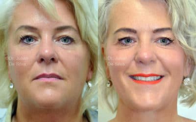 What Maintenance Do I Need After a Facelift?