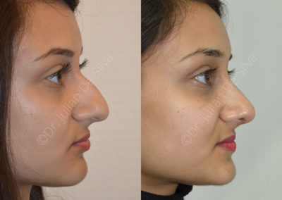 Rhinoplasty in London Before & After Results