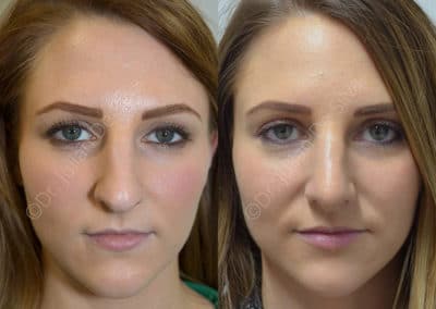 Rhinoplasty in London Before & After Results