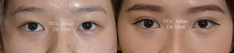 Asian Blepharoplasty in London Before & After Results
