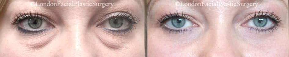 Blepharoplasty in London Before & After Results