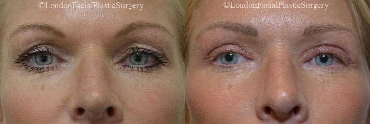 Blepharoplasty in London Before & After Results