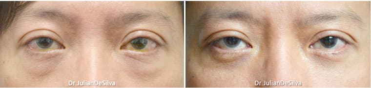 Male Blepharoplasty in London Before & After Results