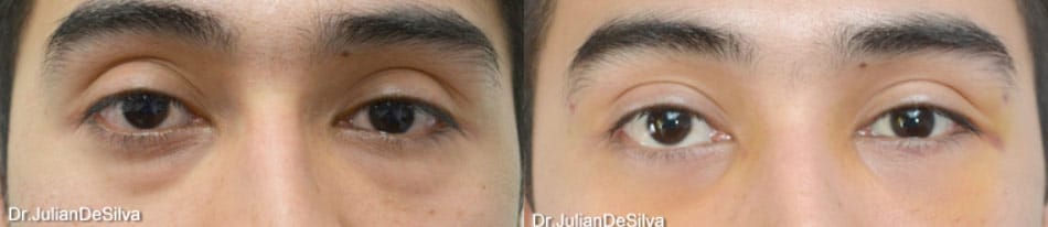 Male Blepharoplasty in London Before & After Results