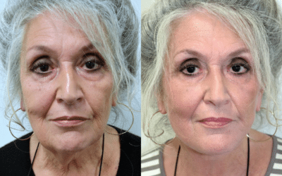 How Long Can You Expect a Facelift to Last?