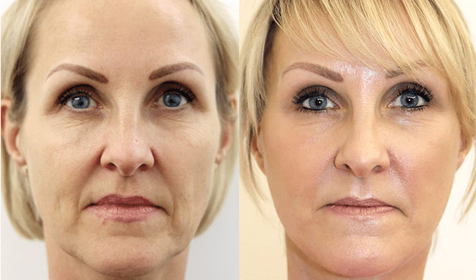 Facelift Surgery in Harley Street, London