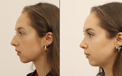 Everything You Should Consider Before Getting a Nose Job