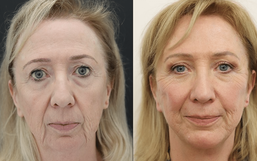 Unveiling the True Essence of World-Class Facelift Surgery